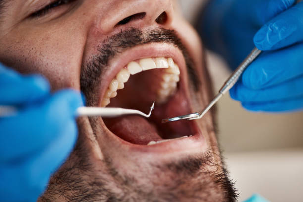 Best Emergency Wisdom Teeth Removal in Anna, OH